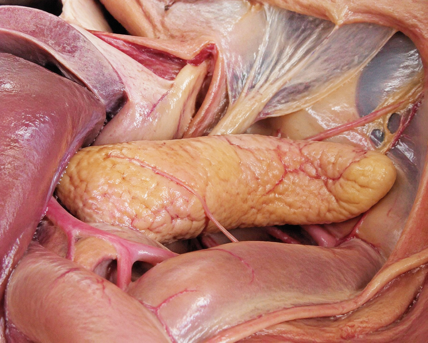 Cancer du pancréas : un nouveau traitement permettrait de doubler la durée de survie des patients