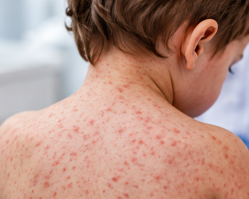 Rougeole aux États-Unis : plus de 4000 cas, le retour inquiétant d’une maladie évitable